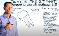 Причины возникновения кариеса эмали зубов